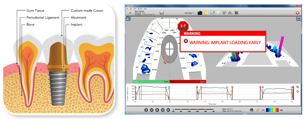 The "Implant Loading Alert" from T-Scan Novus provides clear evidence on whether adjustments may be needed.